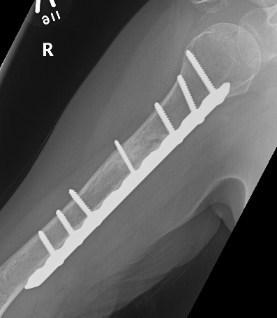 Humerus nonunion plate 2